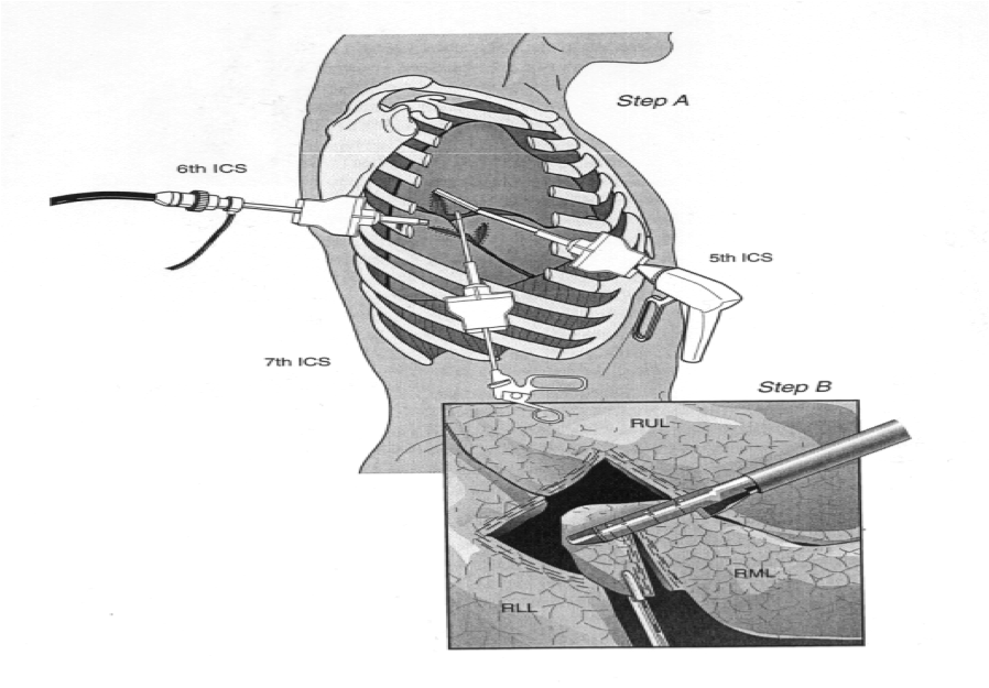 Kirurgisk behandling - RCC Kunskapsbanken