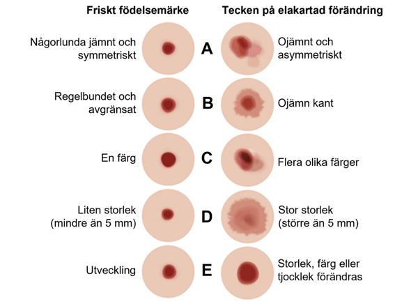 Ett diagram som visar friska födelsemärken samt tecken på elakartade förändringar.