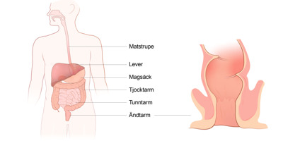 Illustration av tarmkanalen och ändtarmen