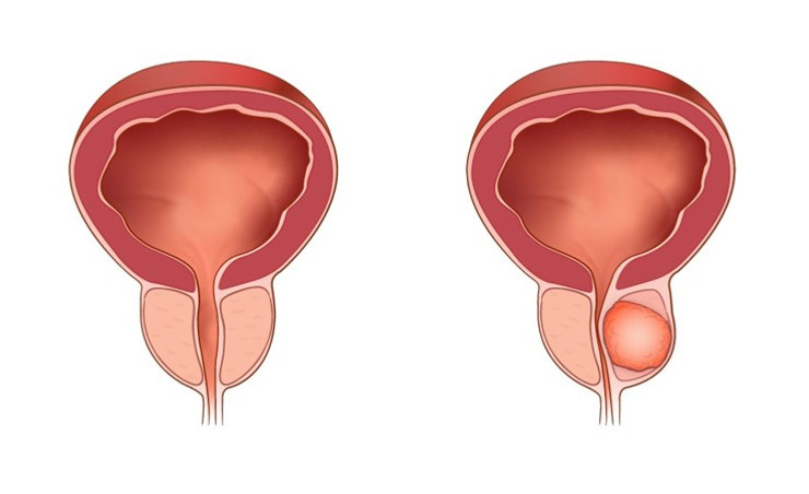Tvärsnitt av urinblåsa, urinrör och prostata. En normalstor prostata påverkar inte urinröret, men en tumör i prostatan kan klämma åt urinröret.