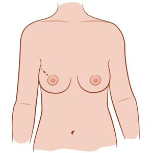 Illustration av bröst vid bröstbevarande operation.