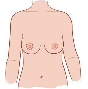 Illustration av bröst vid roundblock.