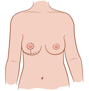 Illustration av bröst vid reduktionsplastik.