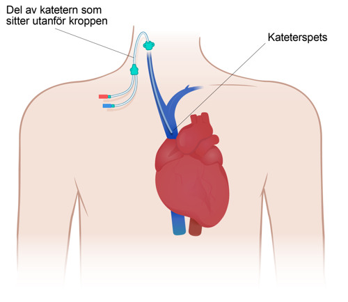 Illustrationen visar axelpartiet d&auml;r en plastkateter &auml;r instucken i ett blodk&auml;rl i halsen och tv&aring; slangar sitter utanf&ouml;r kroppen.