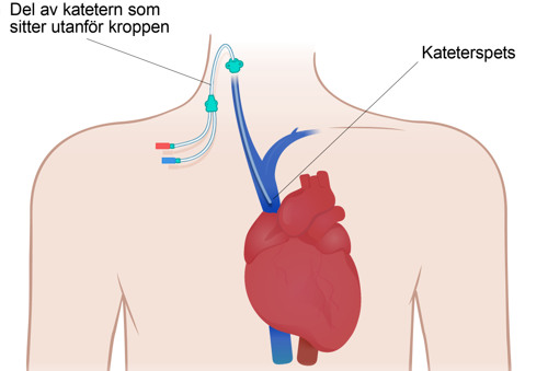 Tecknad bild av en kateter i ett blodkärl. Katetern går genom huden på halsen och ner till hjärtat via ett blodkärl.