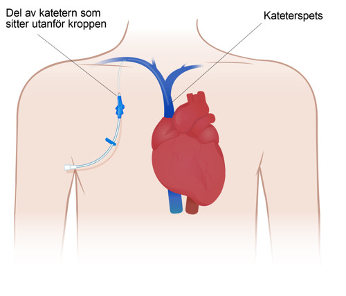 Illustrationen visar axelpartiet och hj&auml;rtat d&auml;r en plastkateter &auml;r instucken en bit under huden och in i ett blodk&auml;rl i halsen och en slang syns utanf&ouml;r kroppen.