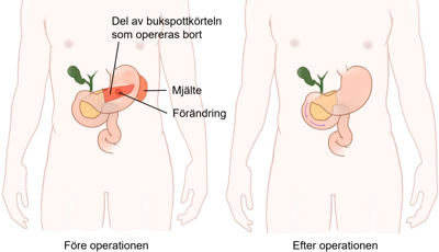 Illustration som visar en del av bukspottskörteln som opereras bort
