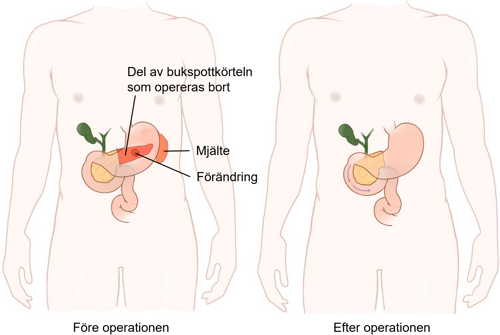 Tvärsnitt av buken före och efter distal pankrearesektion.