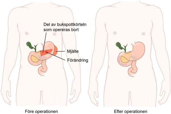 Illustration före och efter operationen.