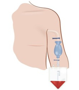 Illustration av dränage från armhålan.