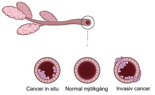 Illustration med cancer in situ, normal mjölkgång och invasiv cancer.