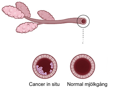 Illustration av cancer in situ och normal mjölkgång.