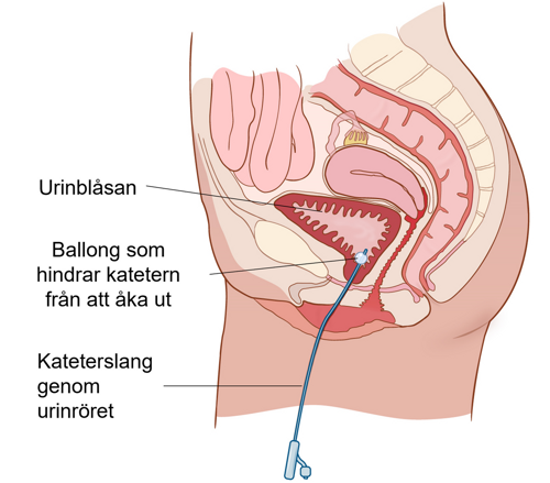 En illustration i genomskärning visar katetern inne i urinblåsan. Katetern har en liten ballong.