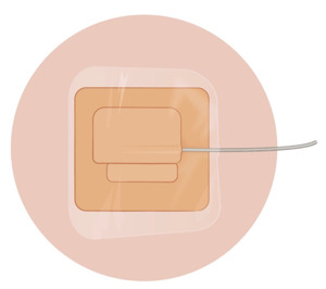 Illustration med fixerande förband till dränage.