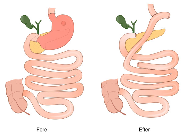 Illustration av total gastrektomi.