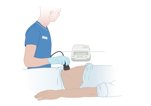 En vårdpersonal använder en ultraljudsstav mot patientens mage för att undersöka hur mycket urin som finns i blåsan.