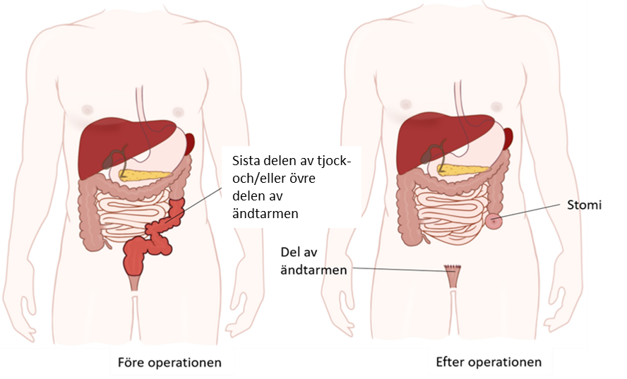 Illustration av buken före och efter operationen.