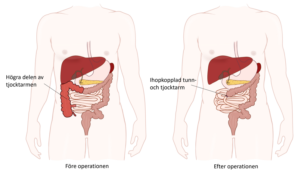 Illustration av buken före och efter operationen.