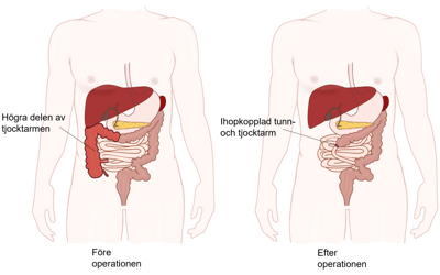 Illustration av hur den högra delen av tjocktarmen tas bort