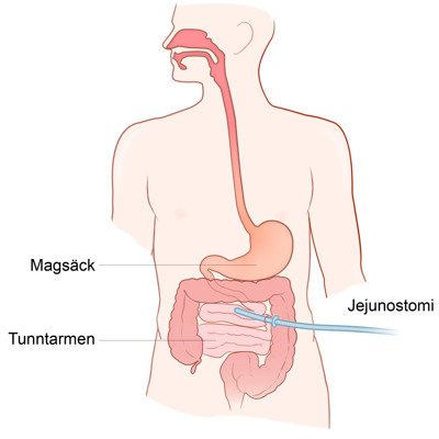 Översiktsbild av magen med en jejunostomi-slang.