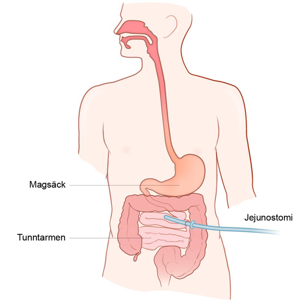 Illustration av mag- och tarmkanalen, med jejunostomin i tunntarmen.