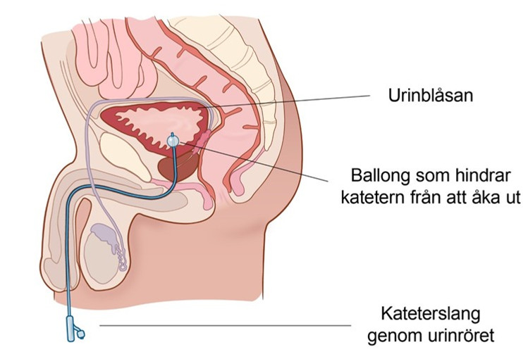 Tvärsnitt av mannens underliv, inklusive urinblåsan, ballong som hindrar katetern från att åka ut samt kateterslang genom urinröret.