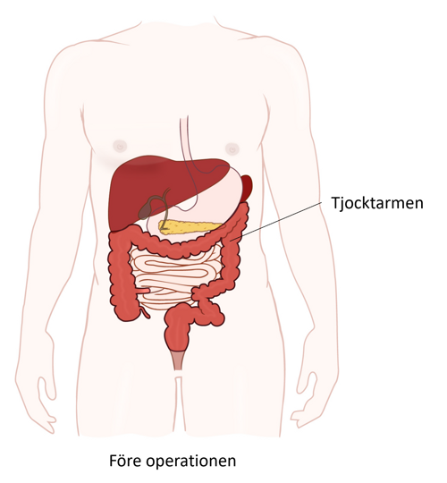 Illustration av buken och tjocktarmen före operation.