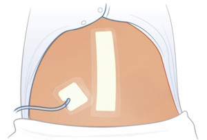 Illustration av mage med slang som går in genom huden.
