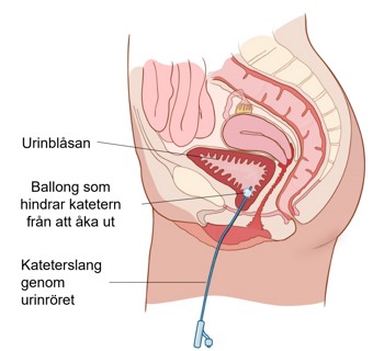Katetern sitter i urinbl&aring;san och t&ouml;mmer den p&aring; urin.