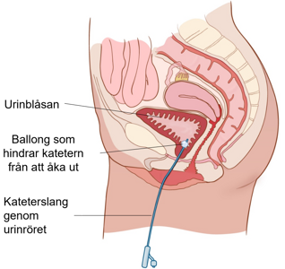Anatomisk bild av bäckenbotten i genomskärning, med kateter i urinblåsan. 