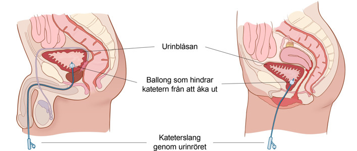 Bäckenbotten av man och kvinna i genomskärning, med kateter i urinblåsan. 