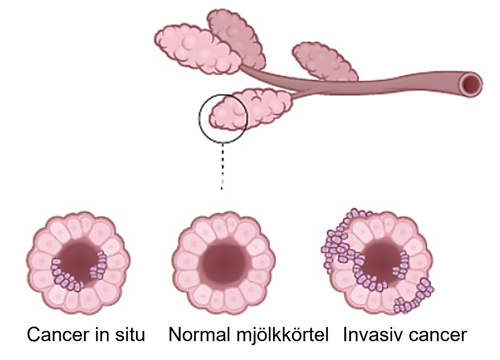 Illustration av cancer in situ, normal mjölkkörtel och invasiv cancer.