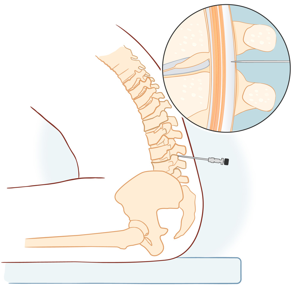 Illustrationen visar ländryggen i genomskärning, där nålens placering är uppförstorad.