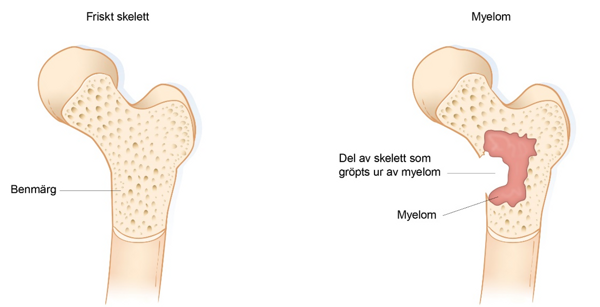 En bild som visar ett normalt ben och ett normalt ben i genomskärning.
