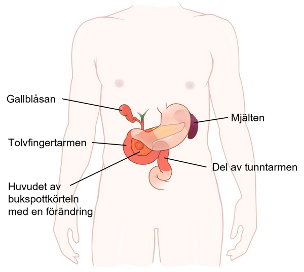 Tvärsnitt med inre organ före operation.