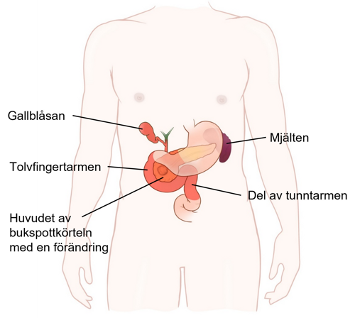 Illustration av bukspottkörtel och kringliggande organ.