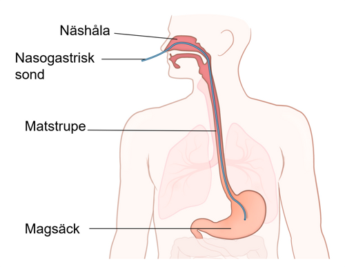 Illustration med näshåla, matstrupe, magsäck samt nasogastrisk sond.