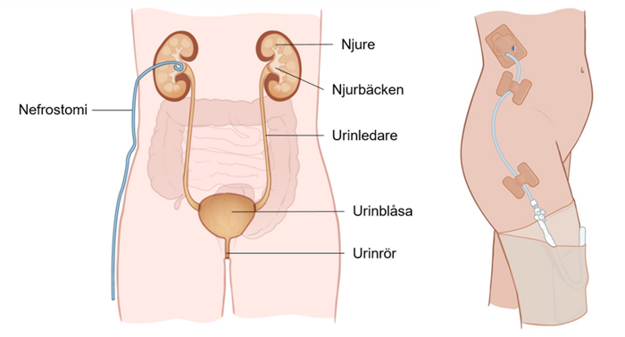 Bilden visar bålen framifrån där en slang går in i en av de två njurarna, man ser även urinledare, urinblåsa och urinrör. På nästa bild, en slang som går in i huden i midjan och leds ner i en påse på låret.