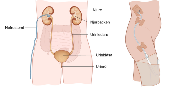 Buken i genomskärning där en tunn slang sitter i njuren och ut genom huden till en urinuppsamlingspåse.