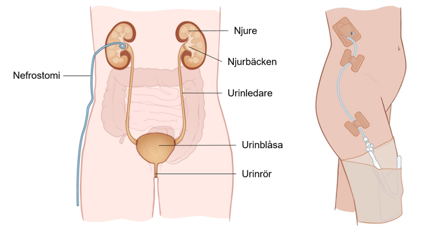 Illustration till vänster: Tvärsnitt framifrån med underliv. Nefrostomin ligger med en tunn slang inuti njuren. Bilden visar också njure, njurbäcken, urinledare urinblåsa och urinrör. Illustration till höger: Bild snett framifrån som visar fixerad slang och en påse som hålls fast i en ficka på benet.