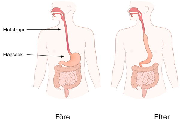 Illustration före och efter operation av matstrupen.