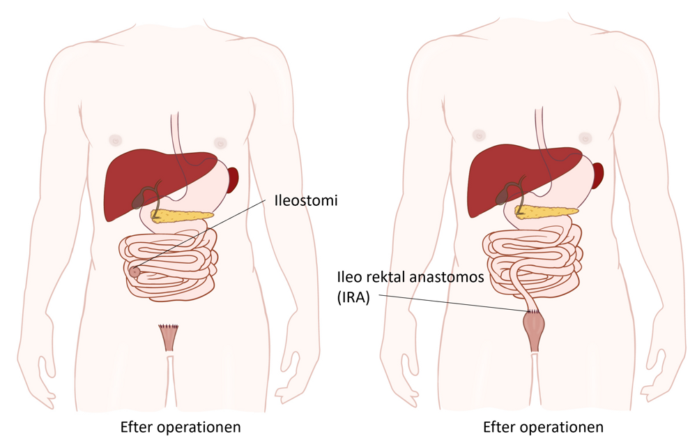 Illustration av buken efter operationen.