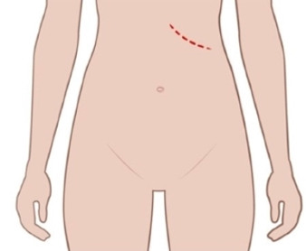 Illustration av mage med operationssnitt.