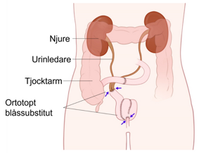 En bild av människokroppen som visar ersättning av urinblåsan.