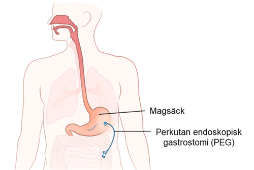 Illustration av magsäck och PEG.