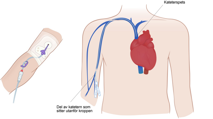Två illustrationer i samma bild visar en slang fäst i höger överarm med ett förband och i den andra bilden ses hjärtat med kateterspetsen precis ovanför.