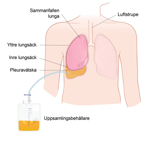 En överkropp i genomskärning visar en sammanfallen lunga med yttre och inre lungsäck samt uppsamlingsbehållare som tappar lungan på pleuravätska.