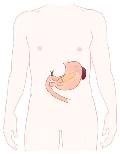 Illustration efter operation med PPPD.