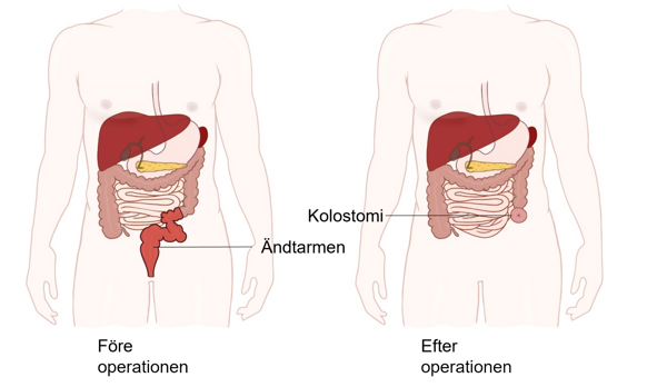 En bild av människokroppen som visar före och efter en rektumamputation.