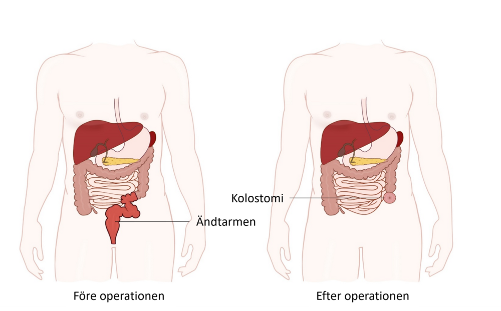 Illustration av buken före och efter operationen.
